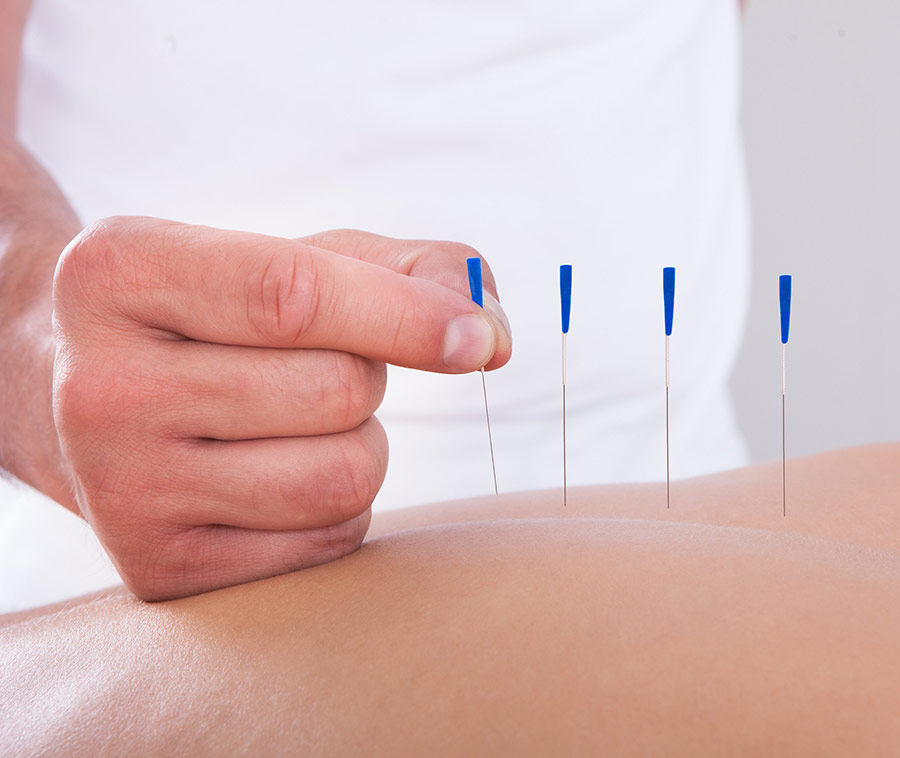 Acupuncture services blue needles in body Acupuncture services blue needles in body