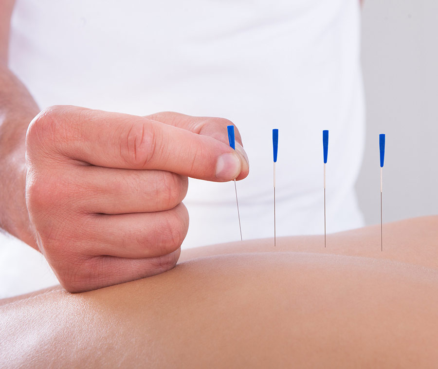 Acupuncture services blue needles in body